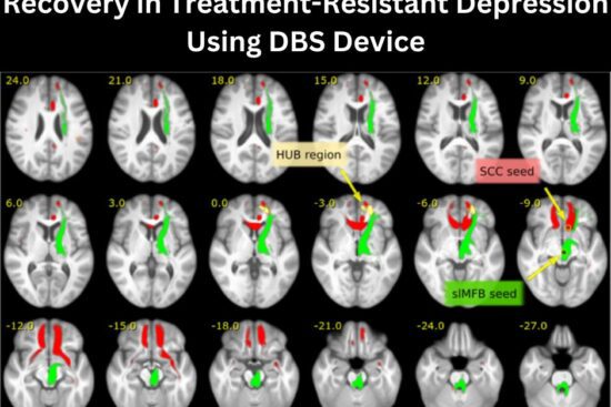 Researchers Identify a Biomarker for Recovery in Treatment-Resistant Depression Using DBS Device